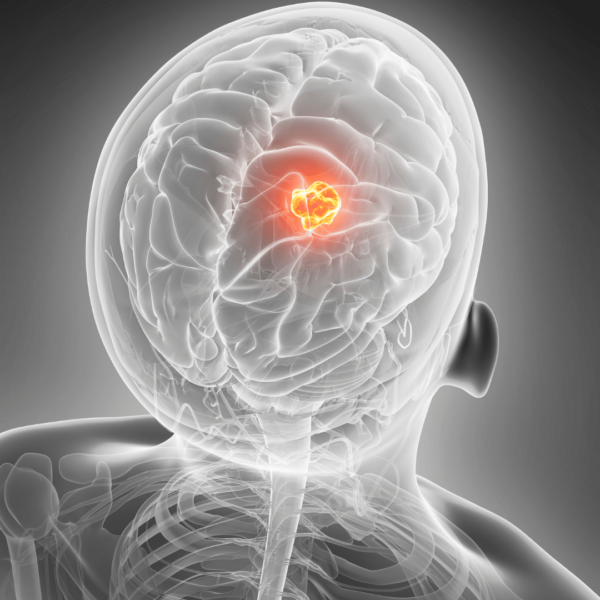 Recuperação Após Cirurgia de Tumor na Hipófise: O Que Esperar