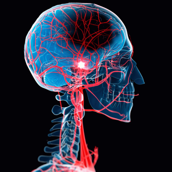 Recuperação de Aneurisma Cerebral e AVC